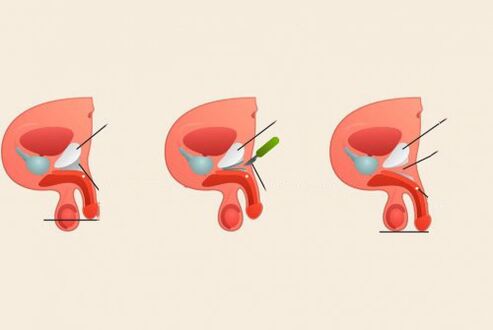 pred in po operaciji za povečanje penisa